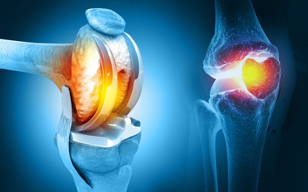 Joint Replacement in Nanded