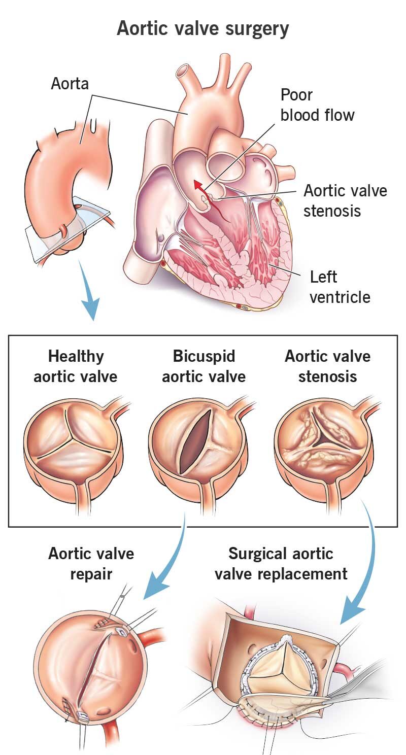 heart valve replacement surgery in Nanded