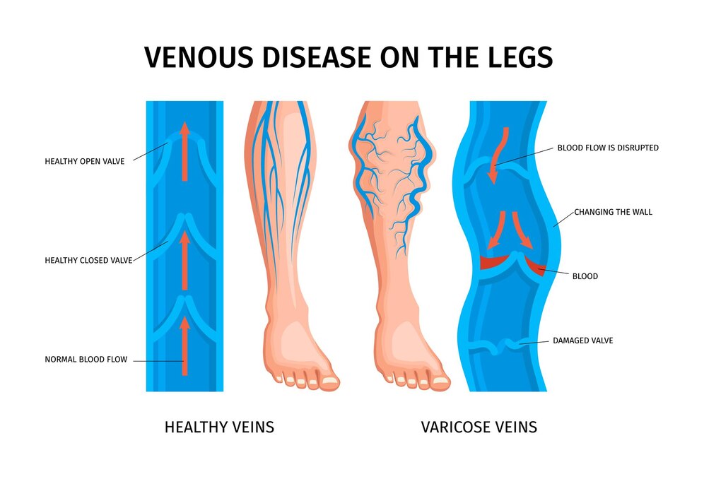 Varicose Veins Treatment in Nanded