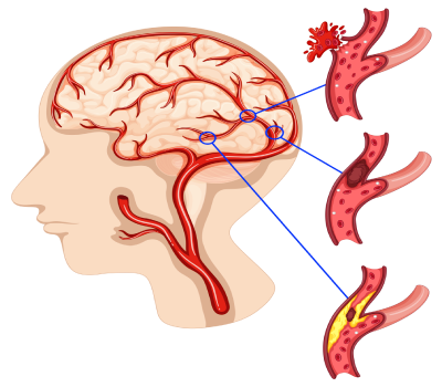 Cerebral Aneurysm Treatment at Shree Ganga Hospital