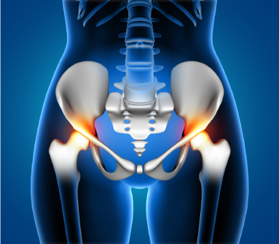 Hip Joint Replacement in Nanded