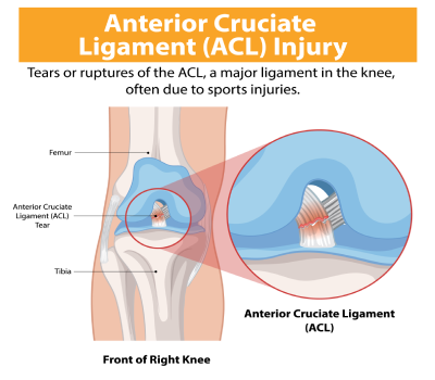 ACL Reconstruction Surgery in Nanded