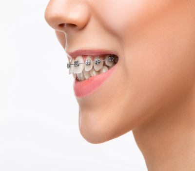 Braces Specialist in Nanded