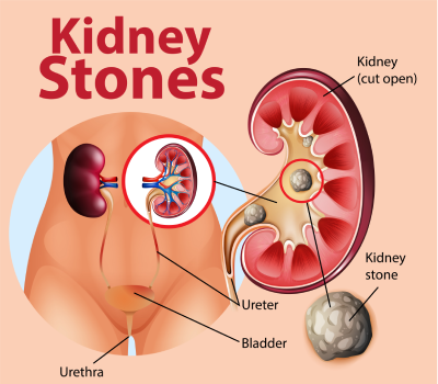 Laser Treatment for Kidney Stones in Nanded